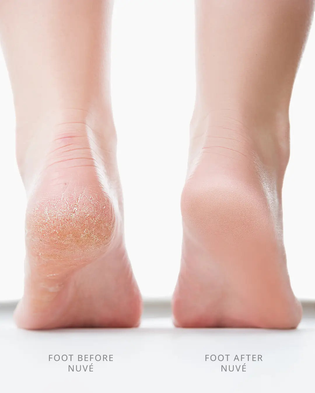 Electric Foot Callus Remover- Professional Foot Cleaner for Dead Skin