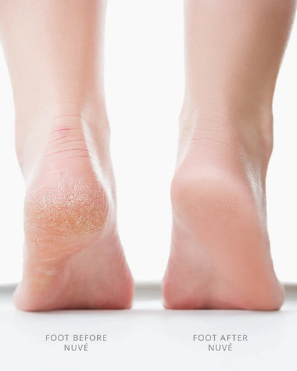 Electric Foot Callus Remover- Professional Foot Cleaner for Dead Skin